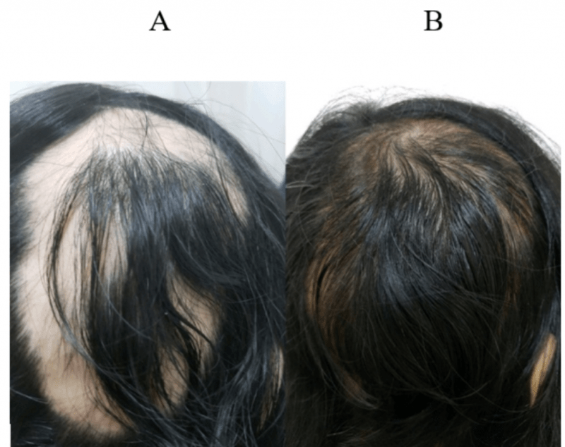 Faktor Yang Mempengaruhi Kerontokan Rambut